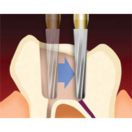 Endo Safe End Endodontic Access Burs