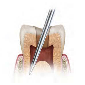 Endo Guide Precision Micro Endodontic Burs